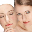 Mesopeeling